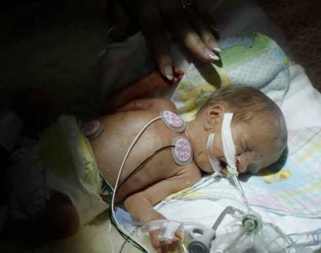 Premature infant with medical monitoring equipment
