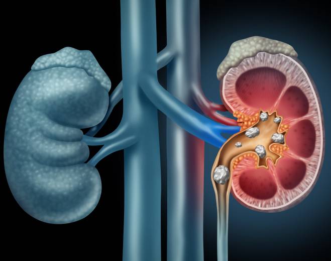 Kidney stones medical illustration