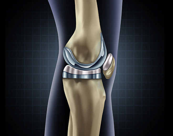 Knee joint replacement medical illustration
