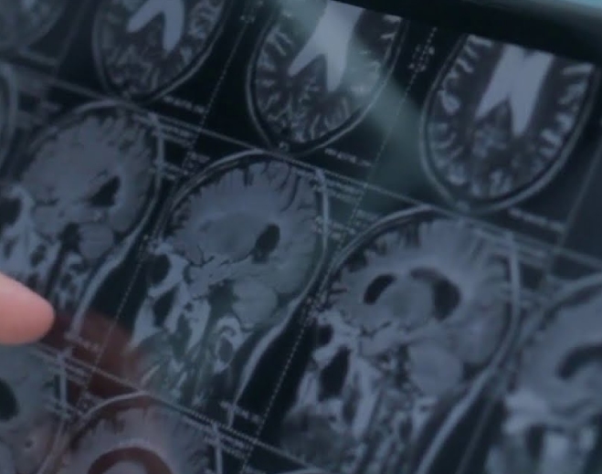 Brain scan medical imaging results