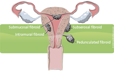 different types of fibroids